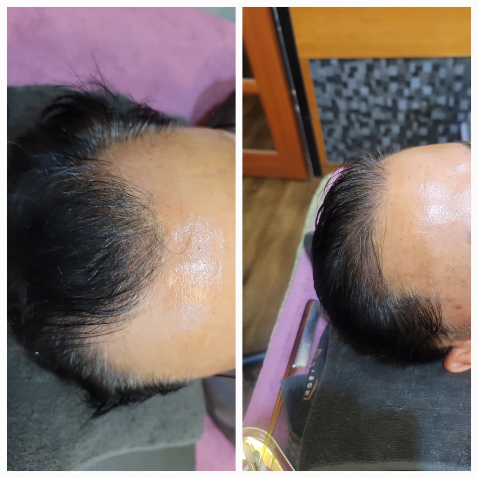 Scalp Micropigmentation — Before & After