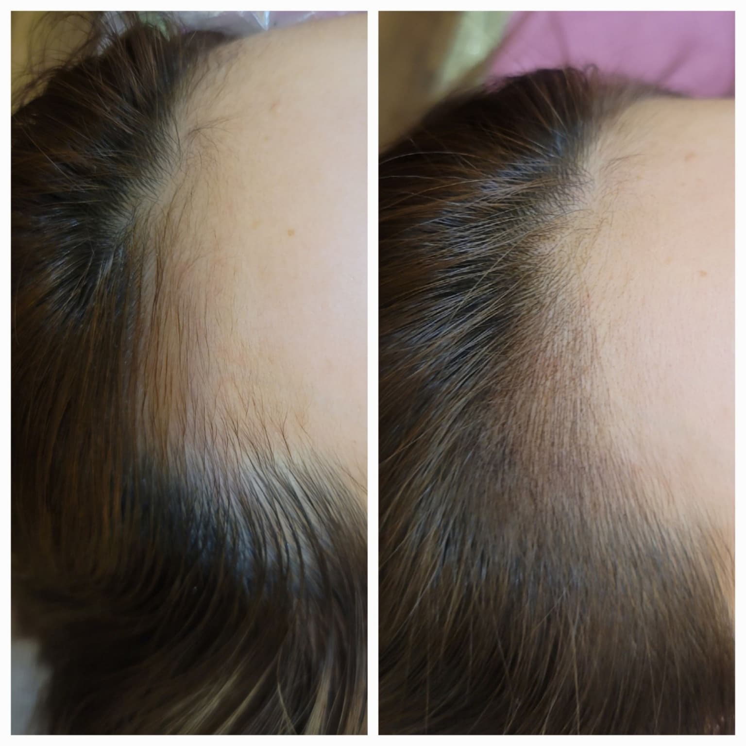 Scalp Micropigmentation — Before & After